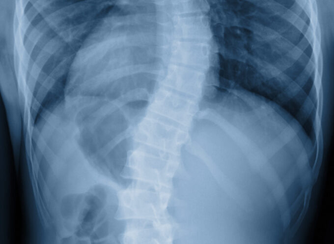 Scoliosis film x-ray show spinal bend in teenager patient